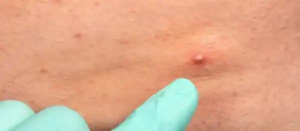 Bacakta Sivilce Oluşumu: Nedenleri ve Dermatolojik Bakış Açısı