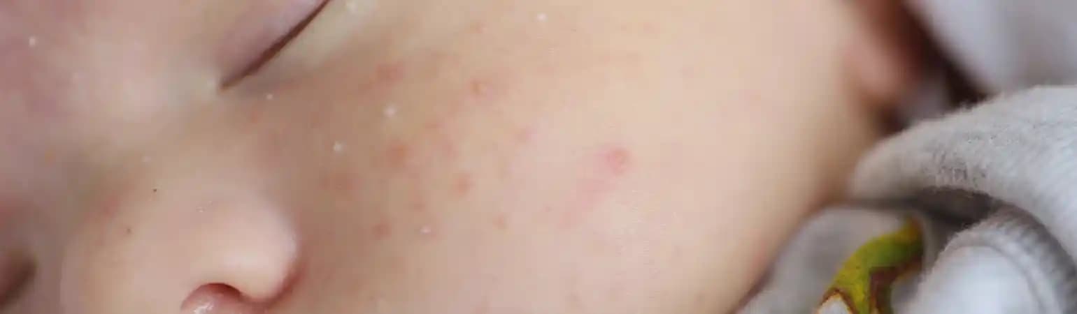 Bebeklerde İltihaplı Sivilce: Temel Bilgiler ve Nazik Cilt Bakımı Yaklaşımları