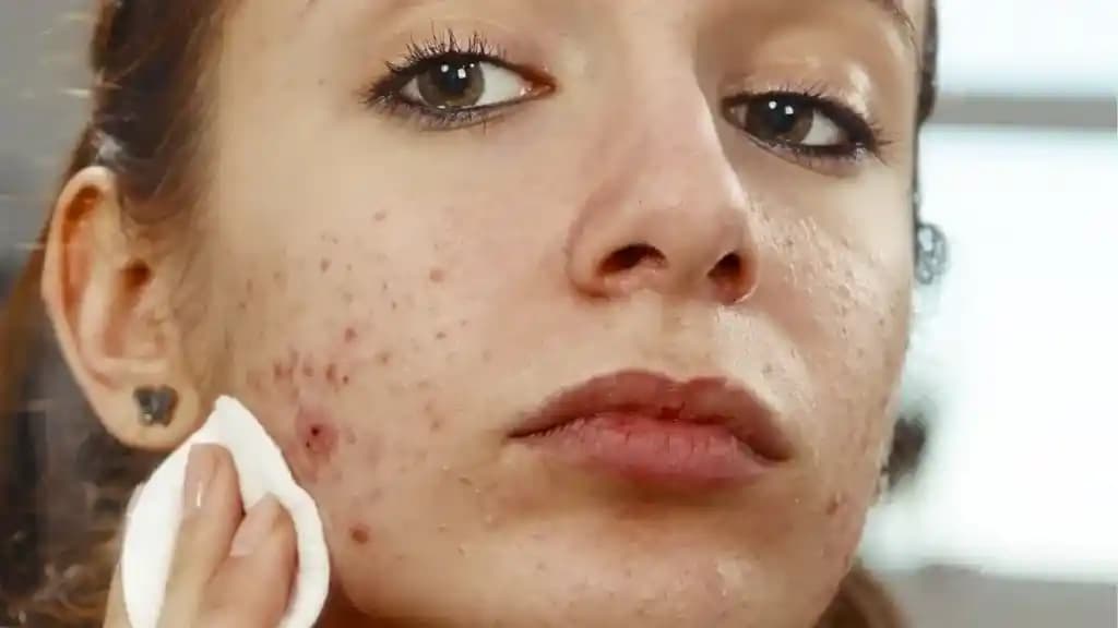 Burun Ucunda Sivilce Oluşumunun Nedenleri ve Dermatolojik Çözümleri