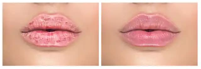 Dudakta Egzama: Belirtiler, Nedenler ve Etkili Bakım Yöntemleri