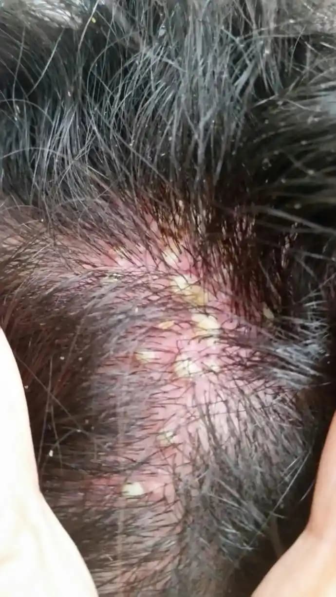 Kafada Çıkan Yaralar İçin İlaç ve Tedavi Yöntemleri: Uzman Önerileri ve Genel Bilgiler