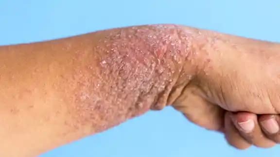 Kolda Egzama: Kaşıntı ve Tahrişin Etkili Yönetimi İçin Nemlendirme ve Cilt Bakımı