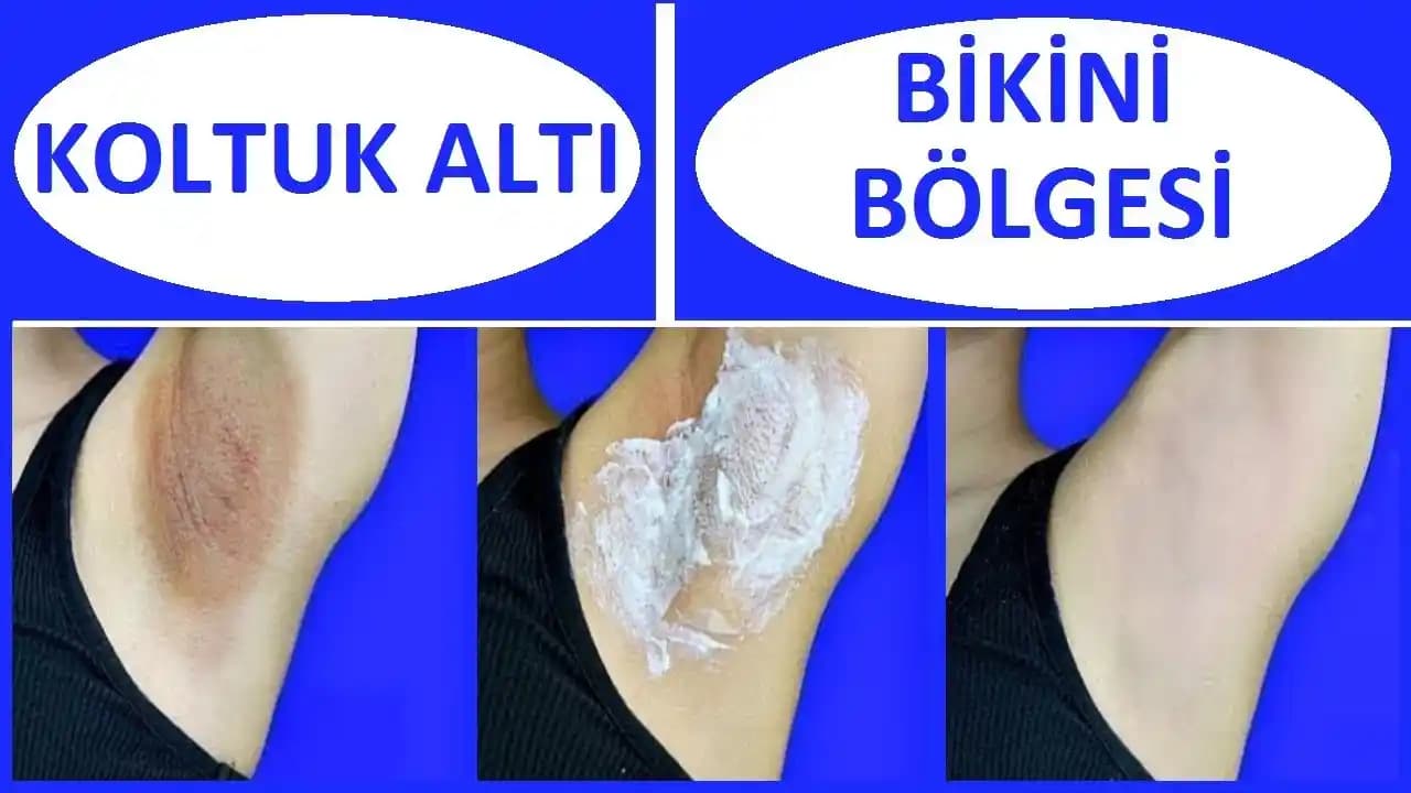 Koltuk Altı Kararmalarının Nedenleri ve Etkili Tedavi Yöntemleri Hakkında Bilgi