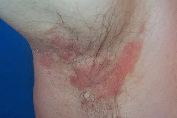 Koltuk Altında Kaşıntı: Kozmetik ve Kişisel Bakım Ürünlerinin Rolü ve Önlemler