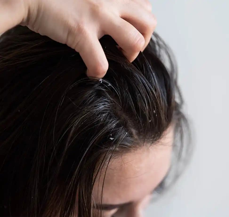 Saç Mantarı Nedir ve Nasıl Tedavi Edilir? Kapsamlı Bilgi ve Yöntemler