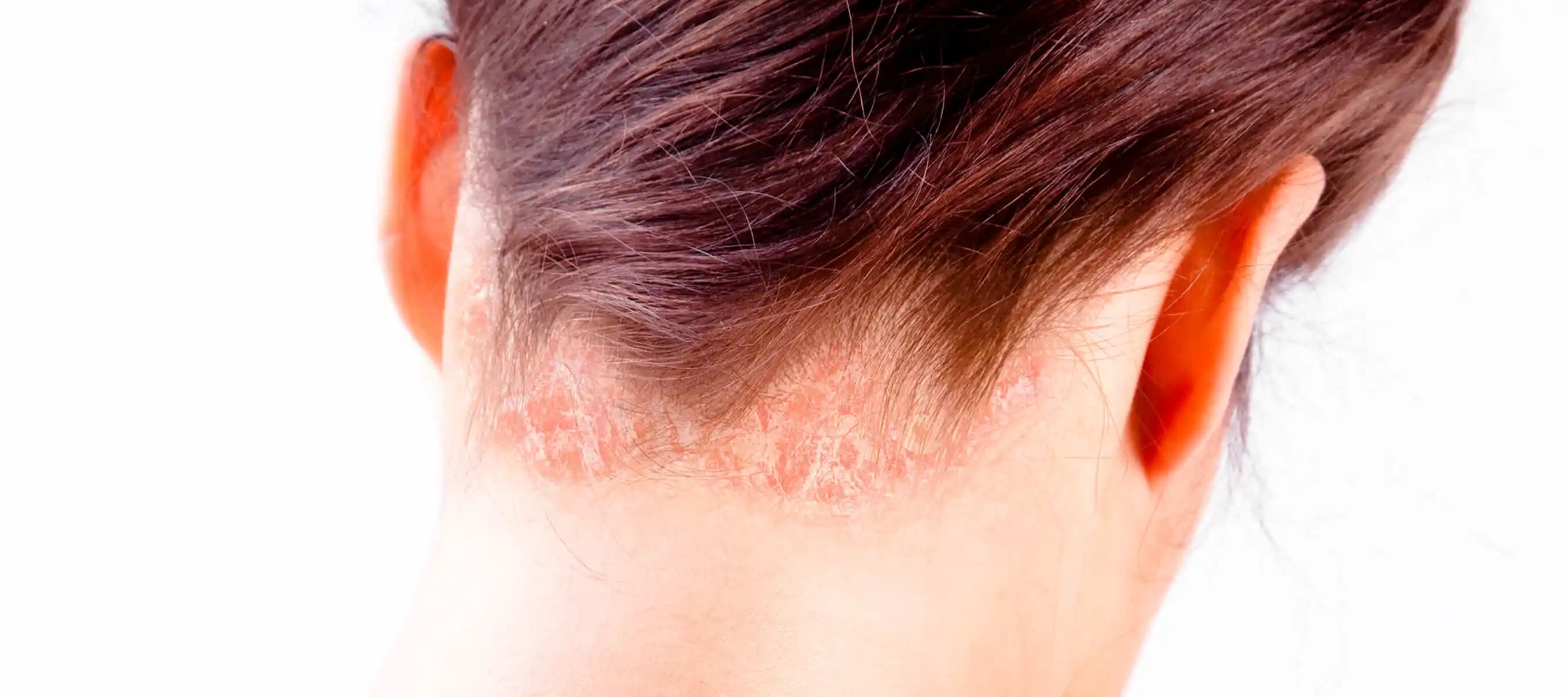 Saçta Sedef Hastalığı: Mevcut Bilgi Durumu ve Araştırma İhtiyacının Değerlendirilmesi