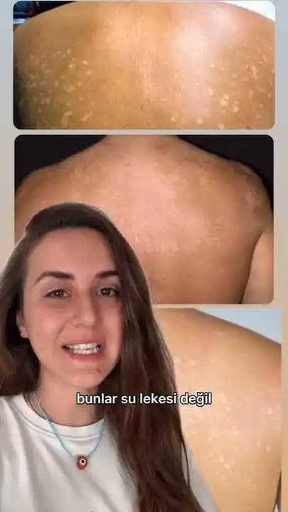 Sırt Lekeleri ve Dijital Alışverişte Ürün Temininin Önemi ve Kullanıcı Deneyimleri