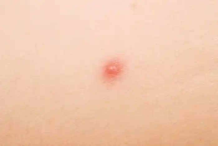 Sırtta Çıban: Belirtileri, Nedenleri ve Etkili Tedavi Yöntemleri Hakkında Bilgi