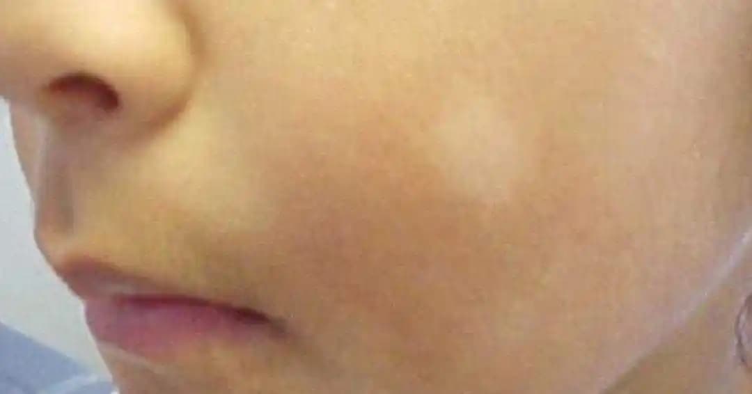 Yüzde Beyaz Lekeler: Nedenleri, Cilt Sağlığı ve Doğru Bakım Yöntemleri