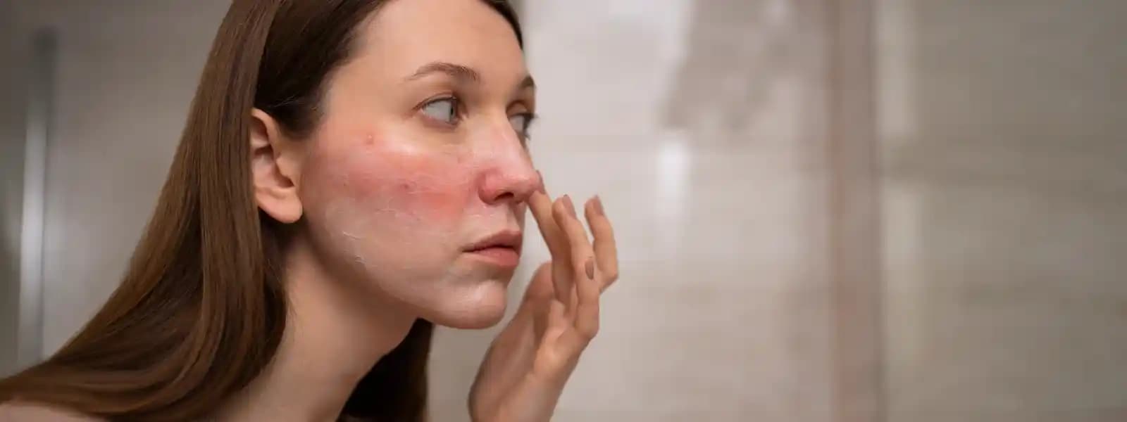 Yüzde Kızarıklık ve Alerji: Ciltte Görülen Reaksiyonların Nedenleri ve Önemi