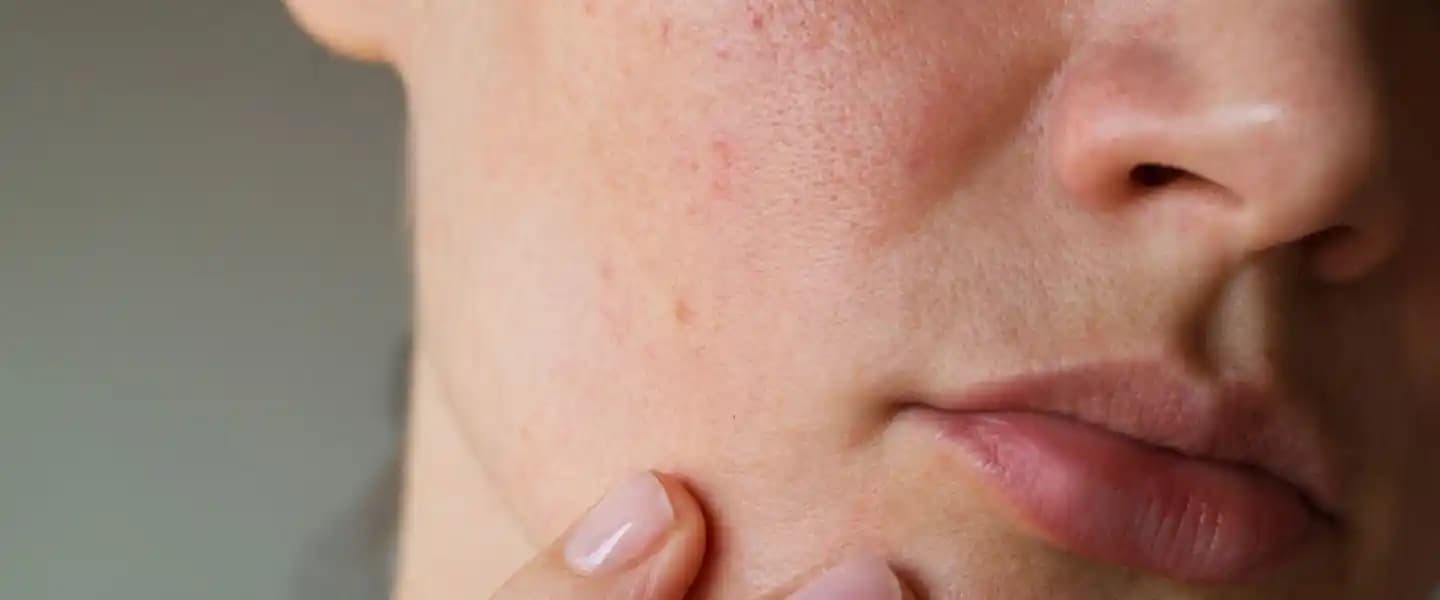 Yüzdeki Kırmızı Lekeler ve Ağrı Yönetimi: Cilt Sağlığında Doğru Tanı ve Tedavi