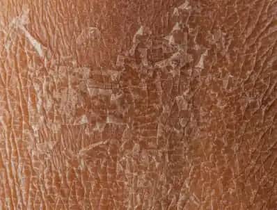 Bacak Kuruluğu Nedenleri, Risk Faktörleri ve Etkili Çözüm Yolları