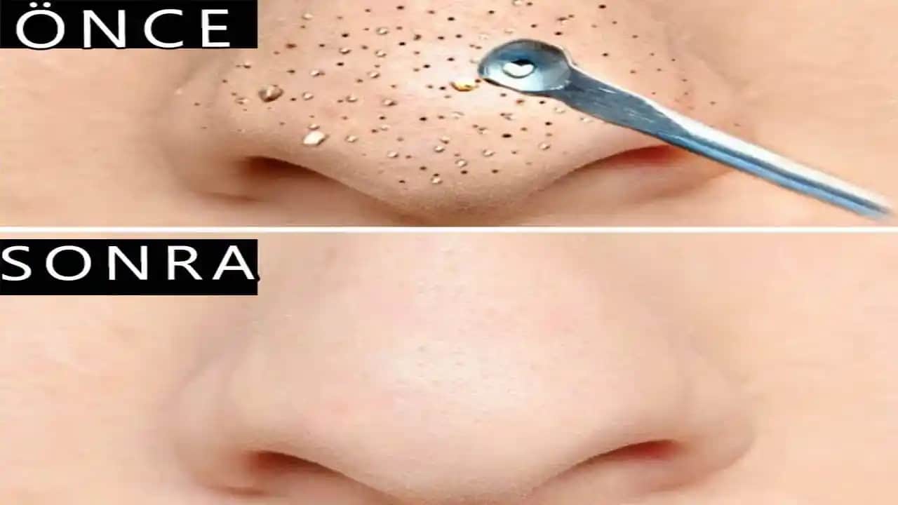 Burun Kenarı Siyah Noktaları Nedenleri ve Etkili Temizleme Yöntemleri Hakkında Bilgi