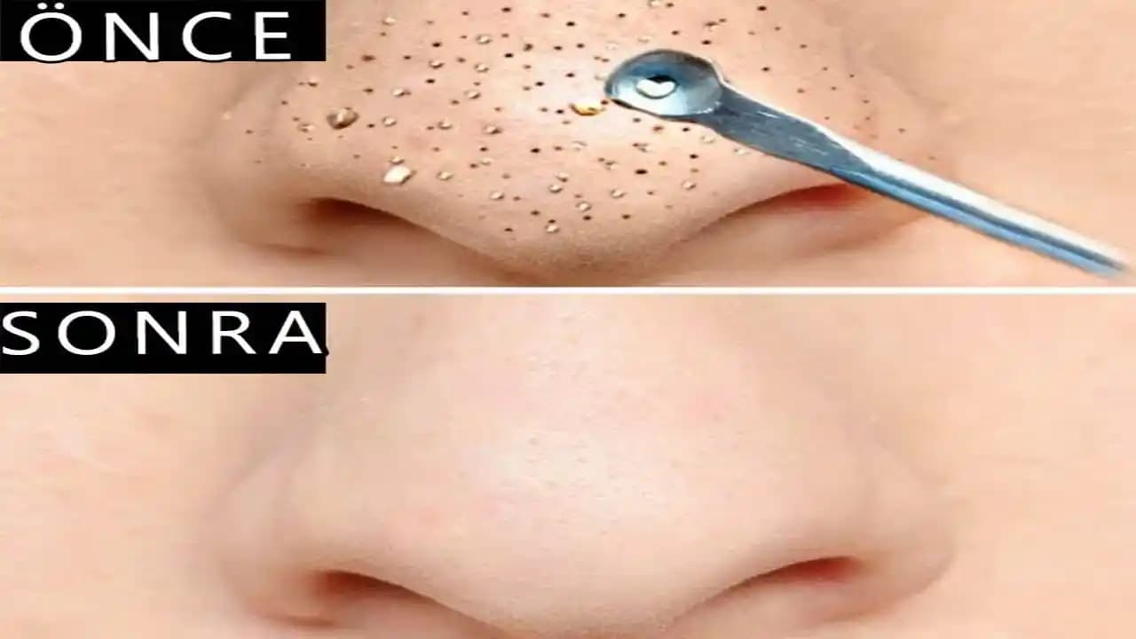 Burun Kenarı Siyah Noktaları Nedenleri ve Etkili Temizleme Yöntemleri Hakkında Bilgi