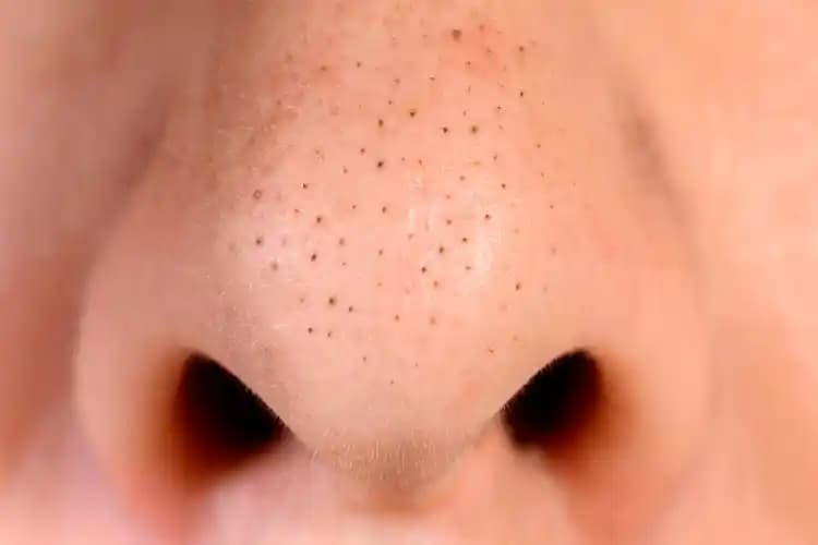 Burun Üstü Siyah Noktalarına Karşı Etkili Tedavi ve Cilt Bakım İpuçları
