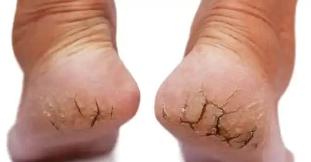 Çatlak Ayaklara Karşı Etkili Bakım Yöntemleri ve Sağlıklı Ayaklar İçin Tavsiyeler