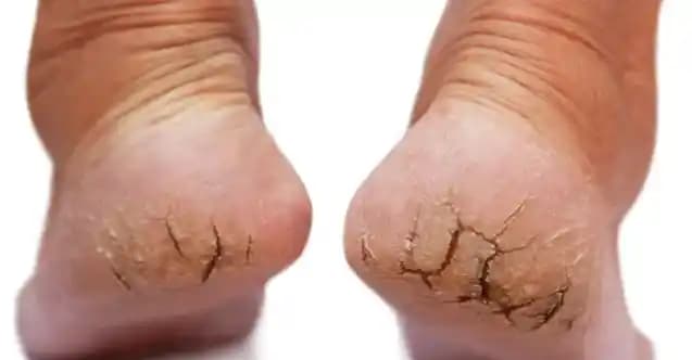 Çatlak Ayaklara Karşı Etkili Bakım Yöntemleri ve Sağlıklı Ayaklar İçin Tavsiyeler