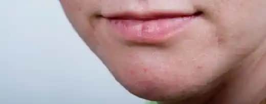 Çenede Kızarıklık ve Pullanma Nedenleri, Tedavi Yöntemleri ve Bakım İpuçları