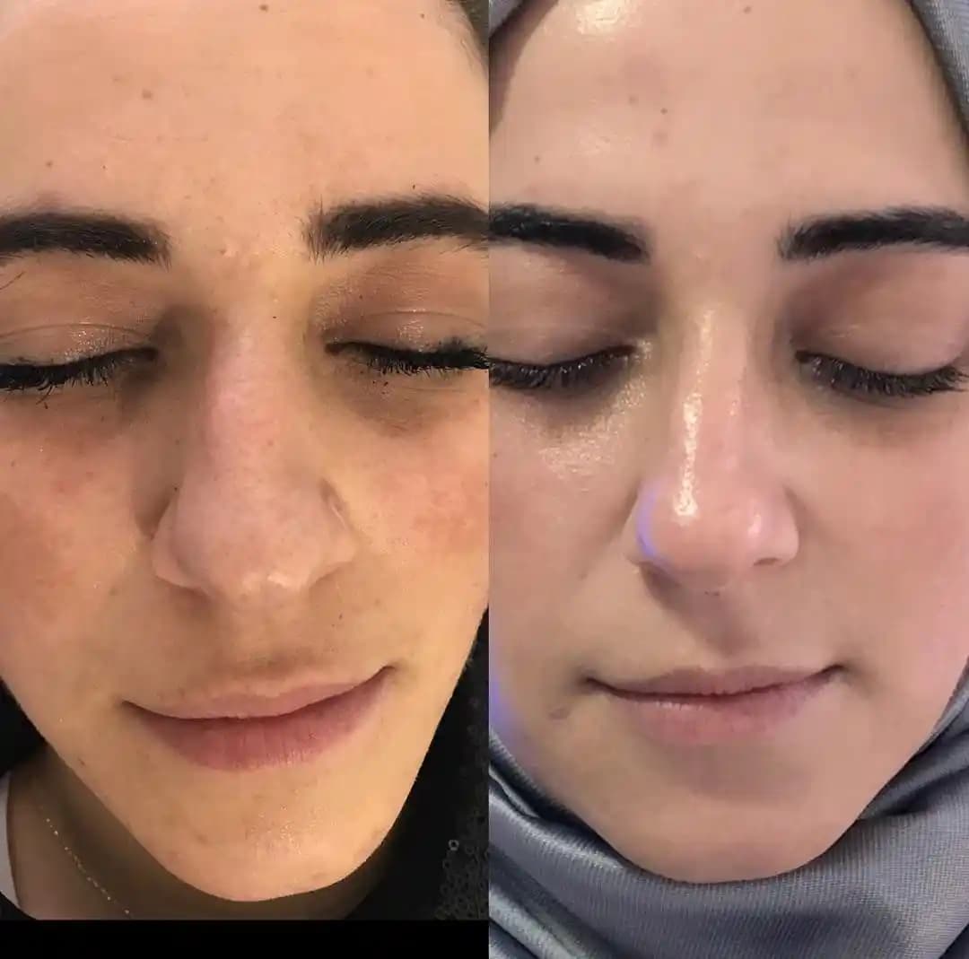 Cilt Gözeneklerini Küçültme Yöntemleri ve Sağlıklı Bir Cilt İçin İpuçları