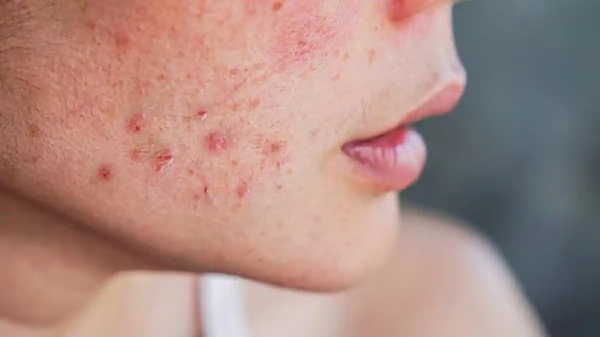 Cilt Lekelerine Karşı Etkili Çözüm Yöntemleri ve Koruyucu Önlemler Rehberi