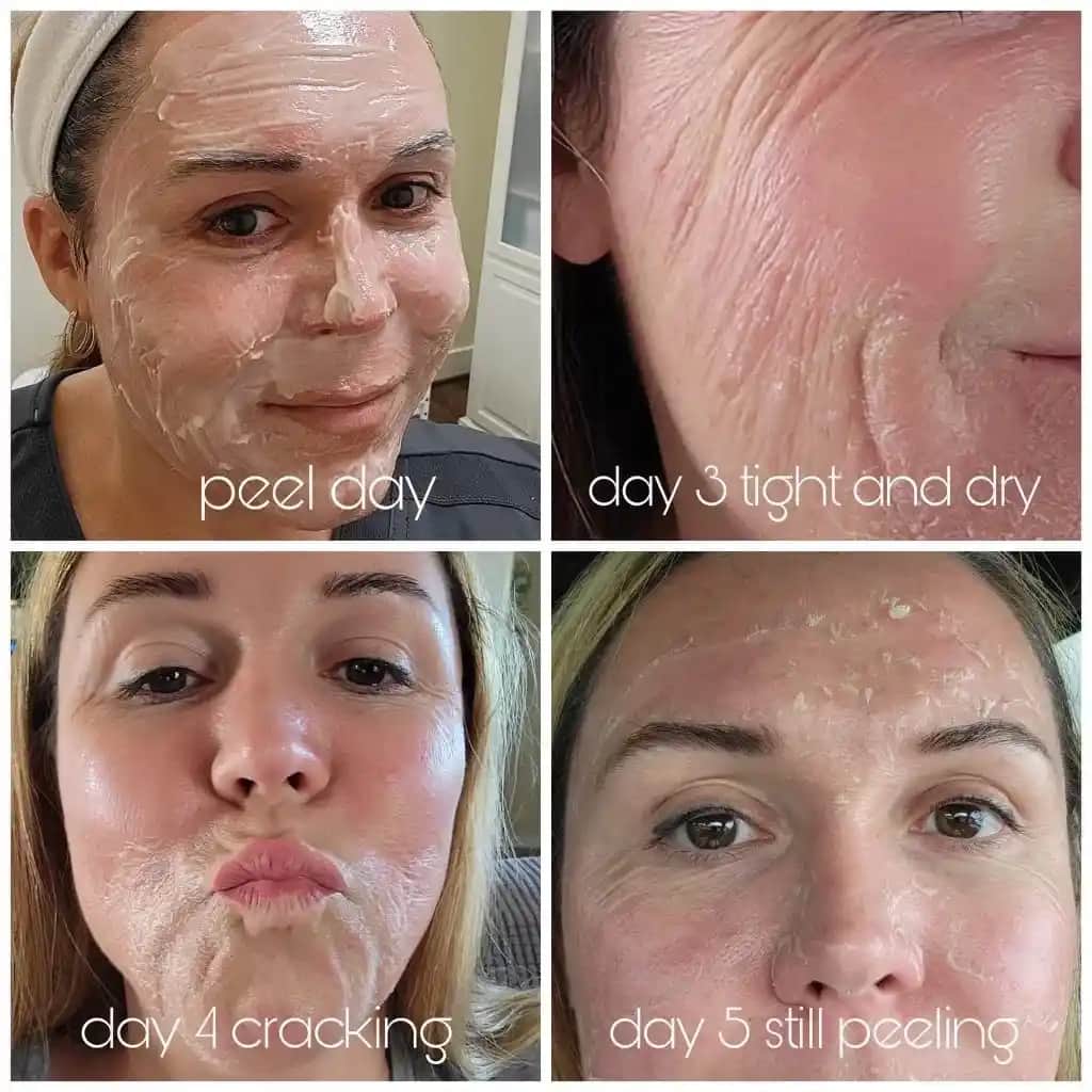 Cilt Yenileme ve Parlaklık İçin Facial Peeling Uygulamaları ve Güncel Trendler