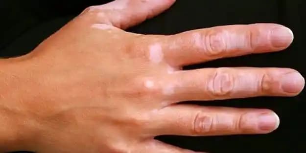 Ciltte Beyaz Leke Nedenleri ve Çözüm Yolları Hakkında Kapsamlı Bilgi