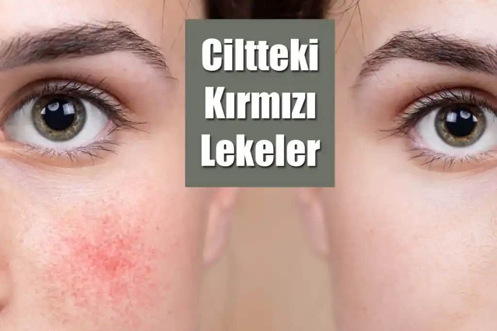 Ciltte Çıkan Lekelerin Nedenleri, Türleri ve Etkili Tedavi Yöntemleri Hakkında Bilgi