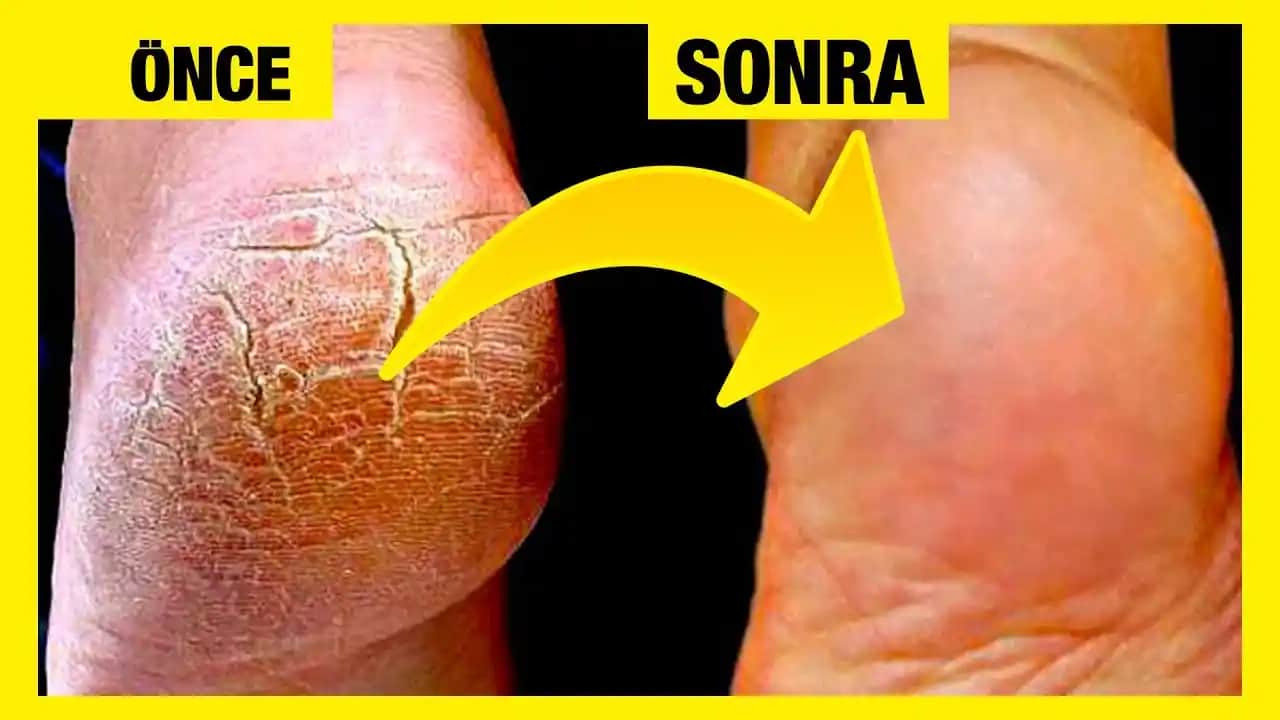 Deri Çatlaklarına Karşı Etkili Yöntemler ve Doğal Çözüm Tavsiyeleri