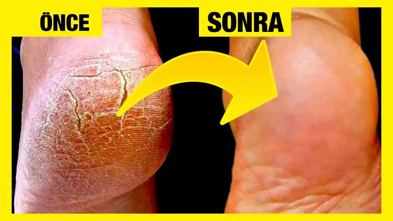 Deri Çatlaklarına Karşı Etkili Yöntemler ve Doğal Çözüm Tavsiyeleri