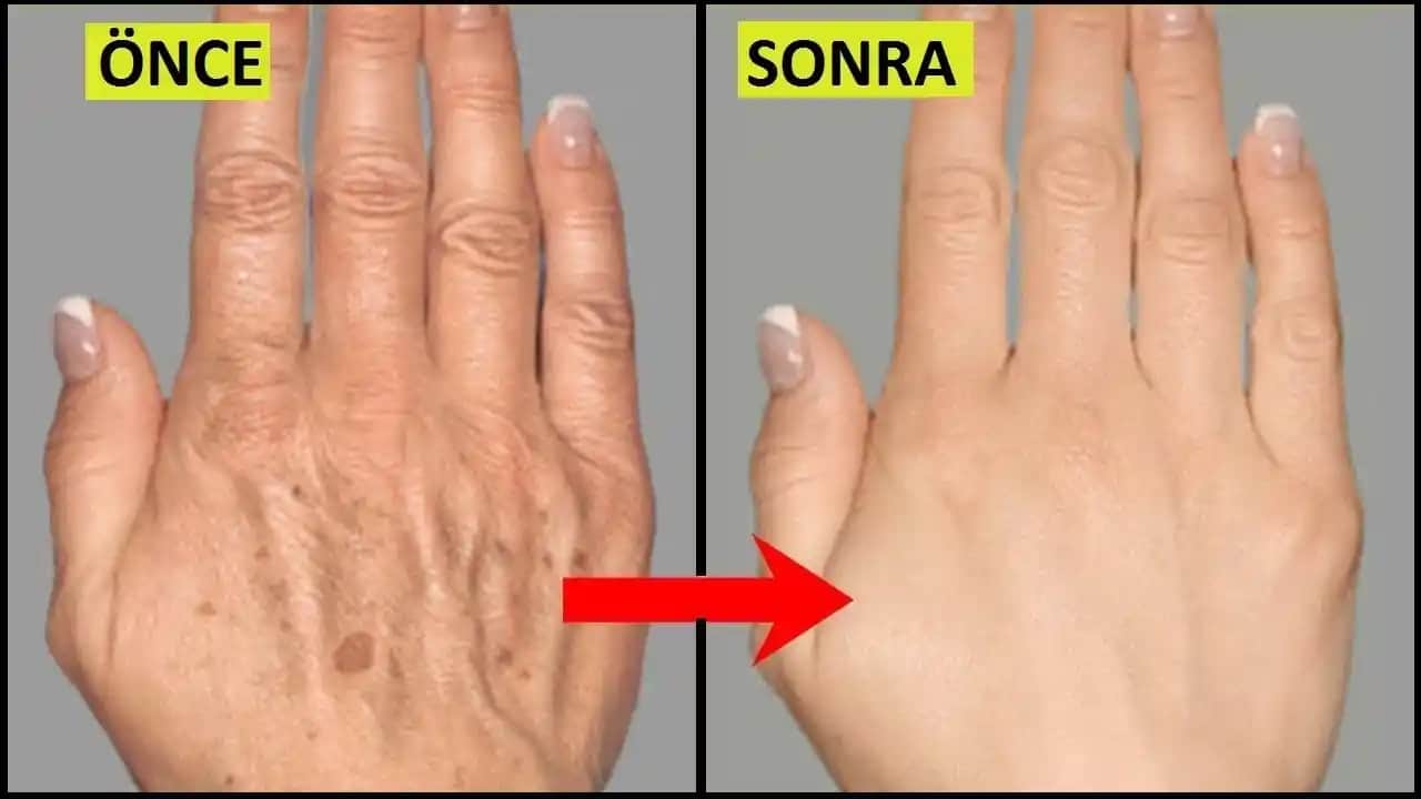 El Lekeleri Nedenleri ve Çözüm Yolları Hakkında Kapsamlı Bilgi ve Kozmetik Bakım Tavsiyeleri