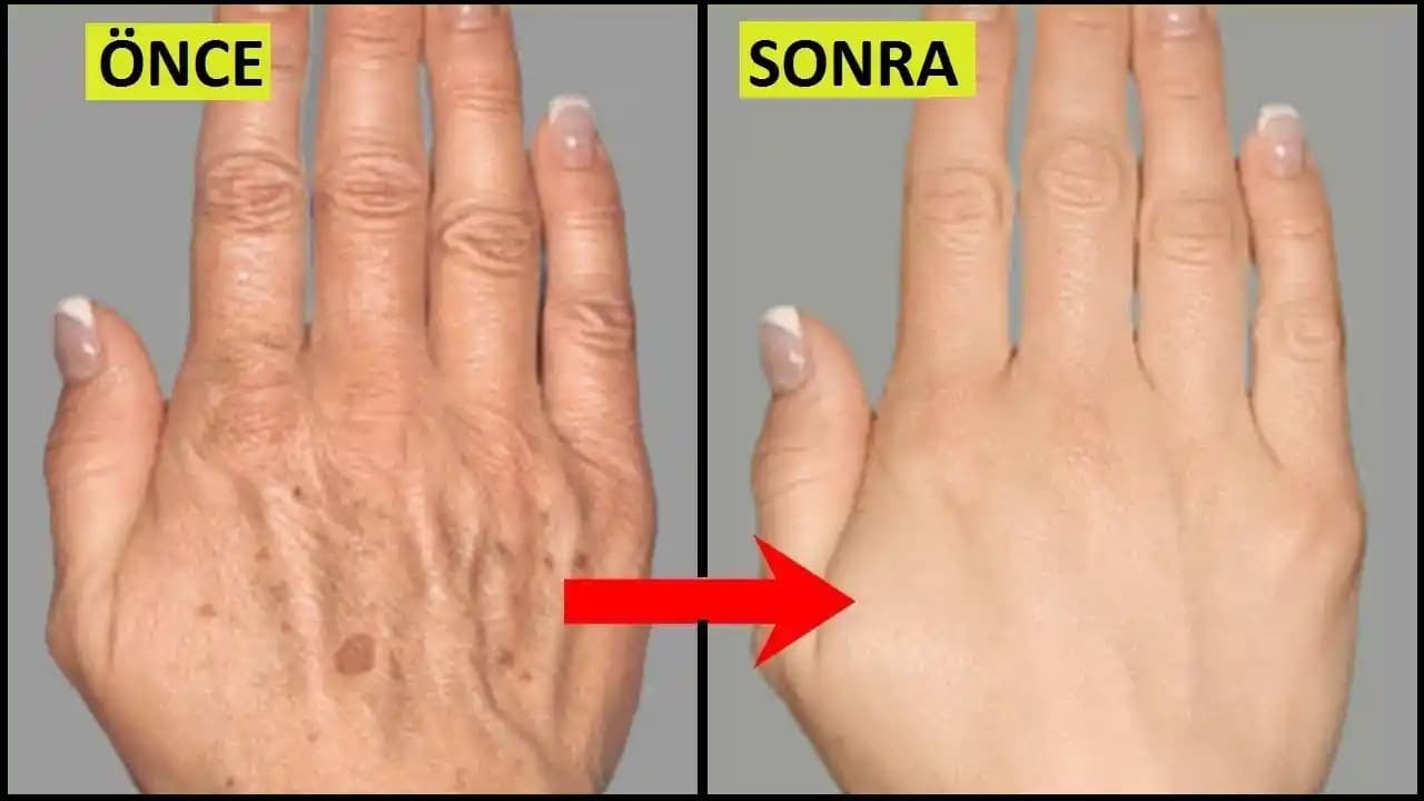 El Lekeleri Nedenleri ve Çözüm Yolları Hakkında Kapsamlı Bilgi ve Kozmetik Bakım Tavsiyeleri