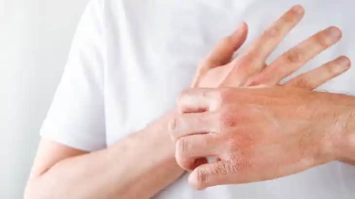 El Tahrişine Karşı Doğru Bakım Yöntemleri ve Doğal Çözümler