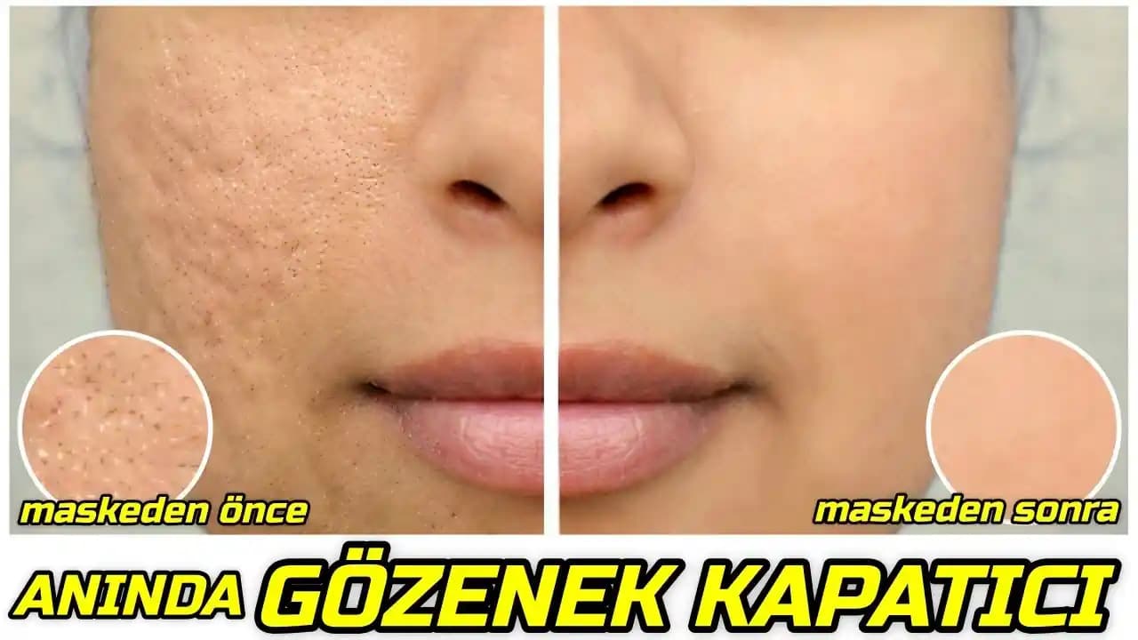 Elde Gözeneklerini Kapatma Yöntemleri ve Cilt Sağlığını Destekleyen Tavsiyeler