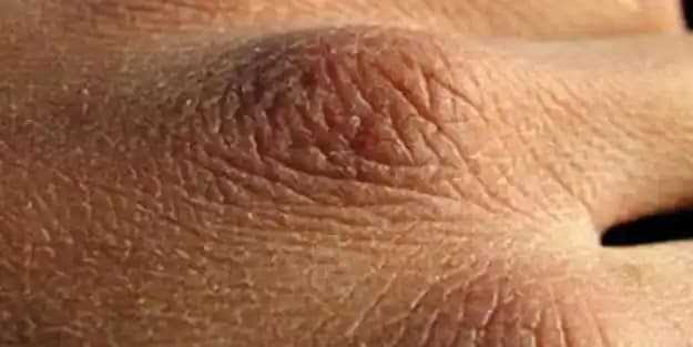 Ellerinizde Çatlama Neden Olur ve Etkili Önleme Yöntemleri Hakkında Bilgi