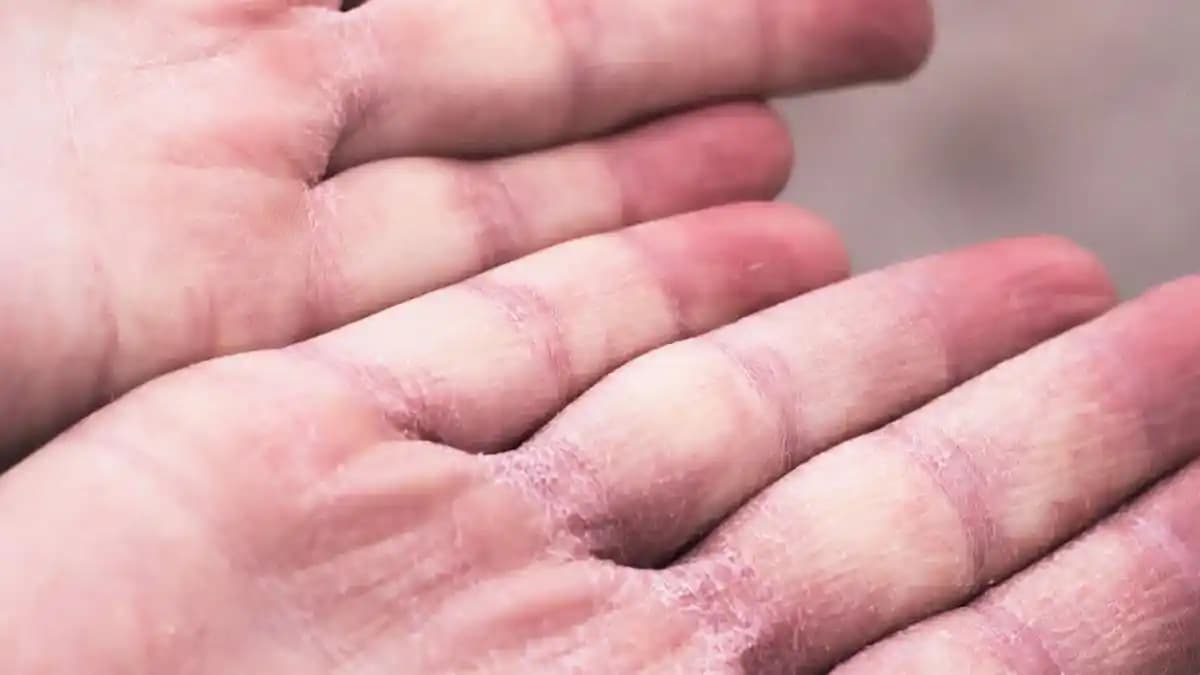 Ellerinizin Çatlamasına Karşı Etkili Doğal ve Güncel Bakım Yöntemleri