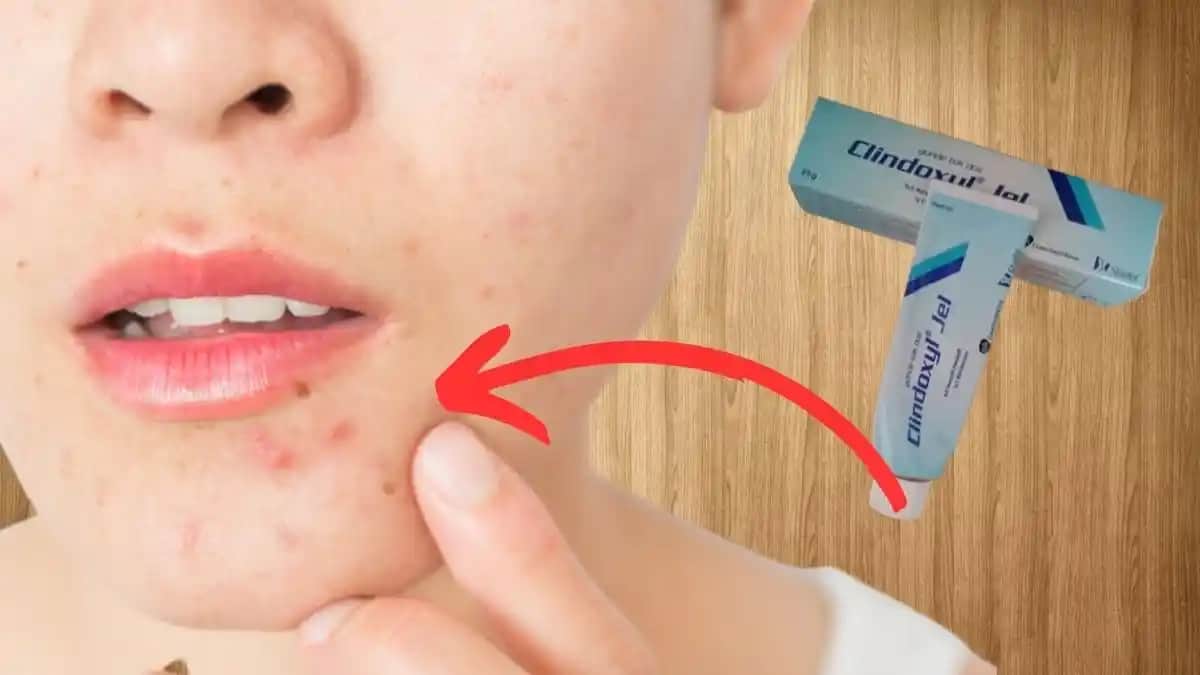 En Etkili Sivilce İlacı ve Cilt Sağlığını Güçlendiren Yöntemler Hakkında Bilgi