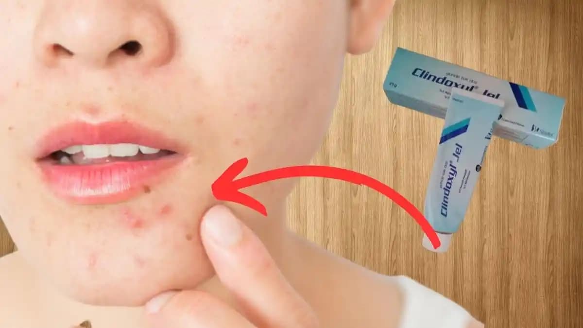 En Etkili Sivilce İlacı ve Cilt Sağlığını Güçlendiren Yöntemler Hakkında Bilgi