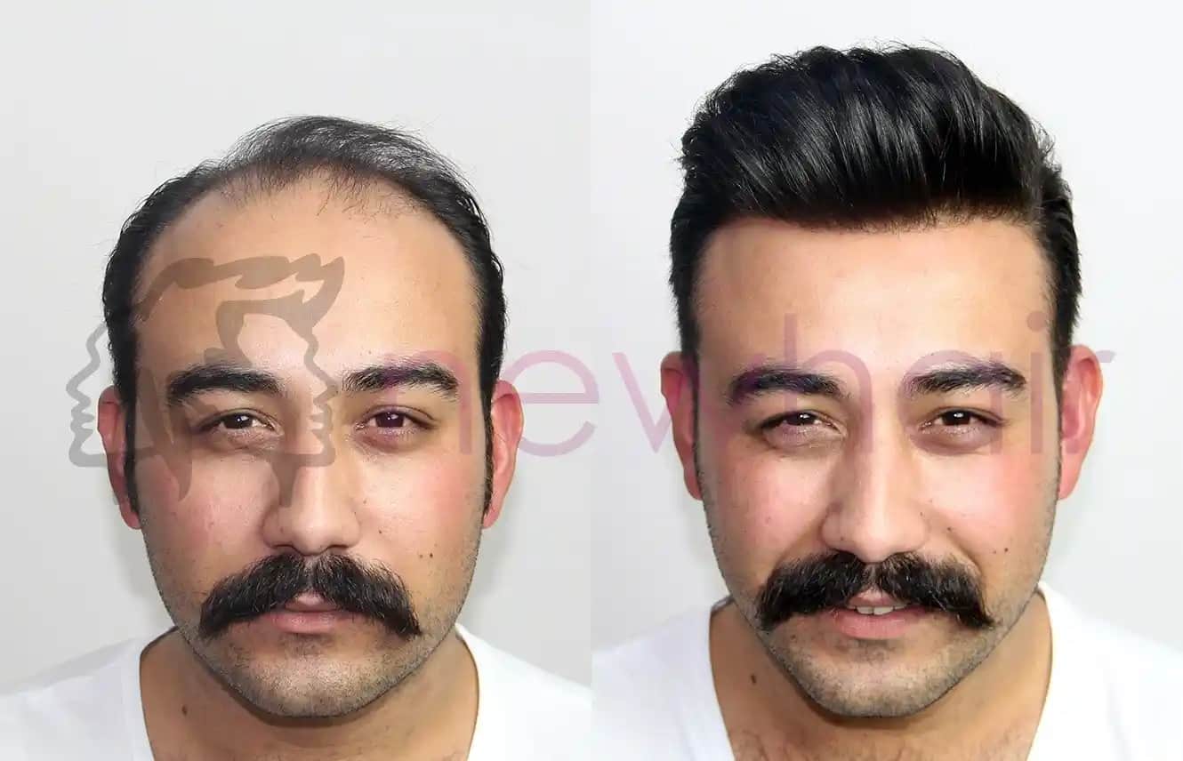 Erkek Protez Saç Nedir, Avantajları ve Uygulama Süreci Hakkında Bilmeniz Gerekenler