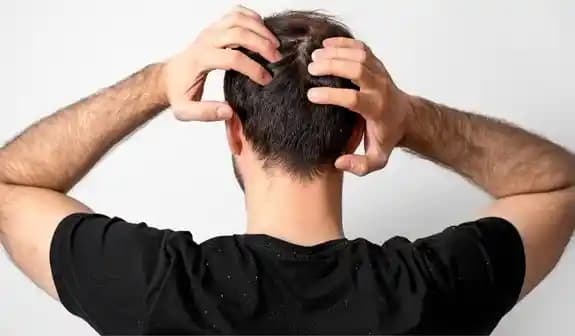 Erkeklerde Kepek Sorunu Nedenleri ve Etkili Çözüm Yolları Hakkında Kapsamlı Bilgi