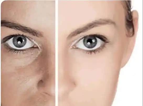 Genç Yaşta Göz Çevresi Kırışıklıklarının Nedenleri, Önlenmesi ve Bakım Yöntemleri