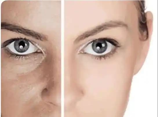 Genç Yaşta Göz Çevresi Kırışıklıklarının Nedenleri, Önlenmesi ve Bakım Yöntemleri