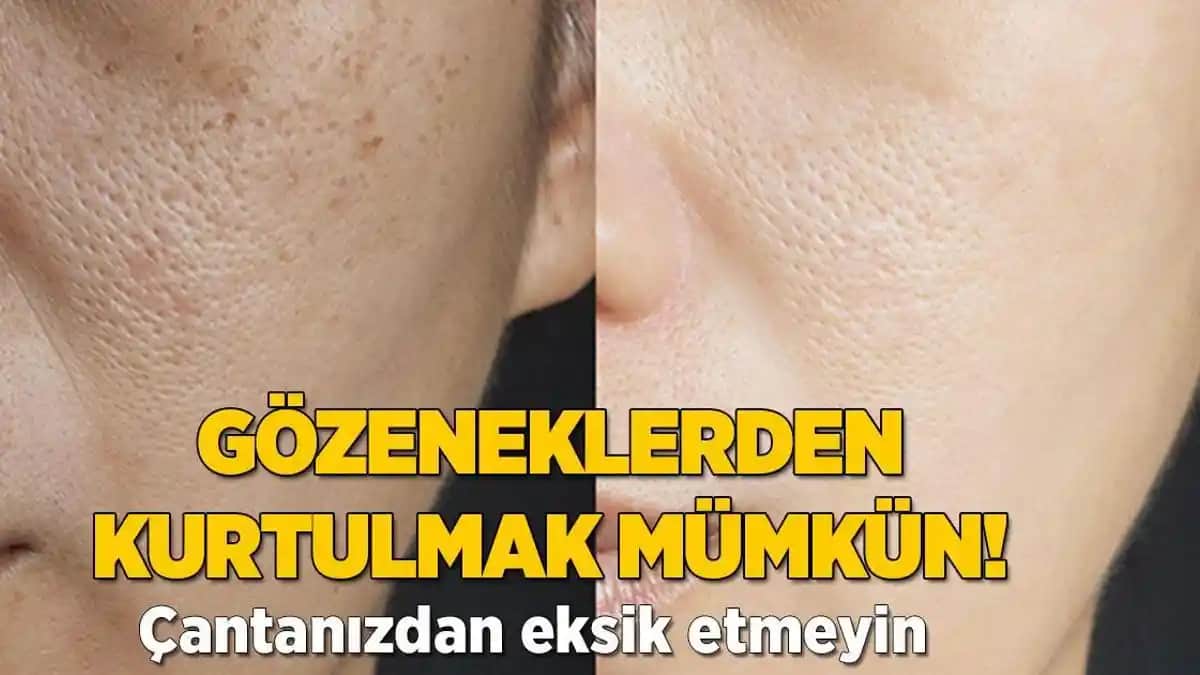 Genişleyen Gözeneklerin Nedenleri ve Etkili Sıkılaştırma Yöntemleri