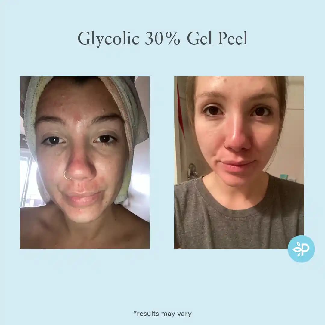 Glycolic Asit Peeling ile Cilt Sağlığını Güçlendiren Etkili Yöntemler ve Uygulama Rehberi