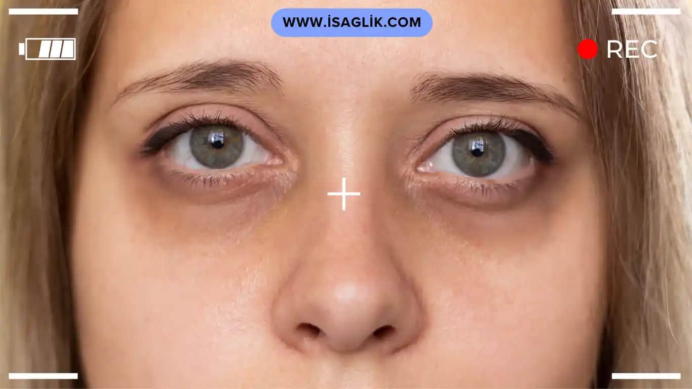 Göz Altı Çizgileri İçin Etkili Bakım Yöntemleri ve Doğal Çözümler