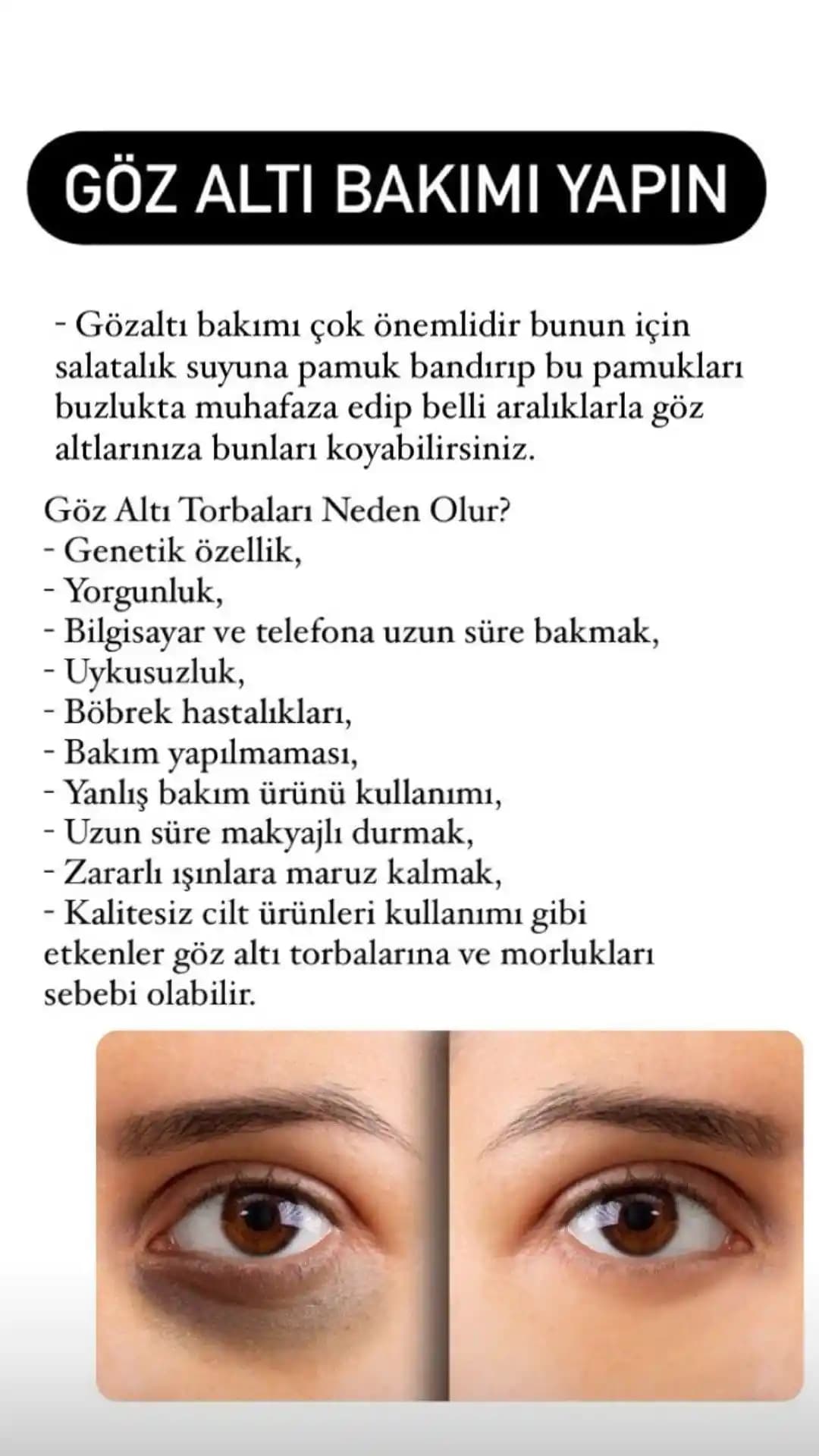 Göz Altı Sıkılaştırma Yöntemleri ve Bakım İpuçları ile Genç Bakışlar