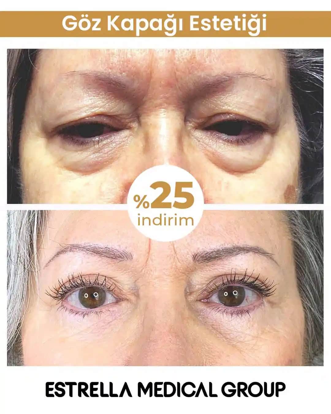 Göz Kapaklarındaki Kırışıklıkların Nedenleri ve Etkili Önleme Yöntemleri