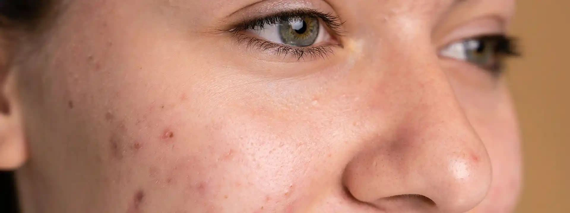 Gözenek Genişlemesinin Nedenleri ve Etkili Sıkılaştırma Yöntemleri