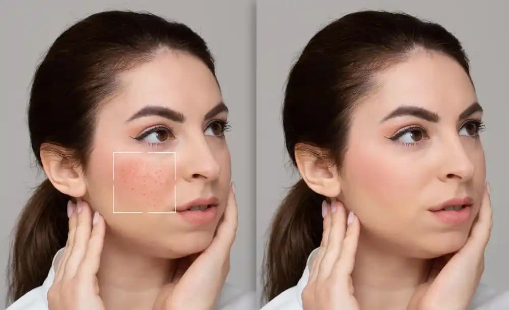 Gözenek Lazer Tedavisi Nedir ve Genişleyen Gözenekleri Nasıl Sıkılaştırır