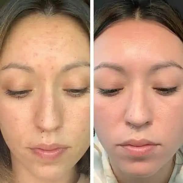 Gözenek Tıkanması ve Cilt Sağlığı: Nedenleri, Belirtileri ve Korunma Yöntemleri