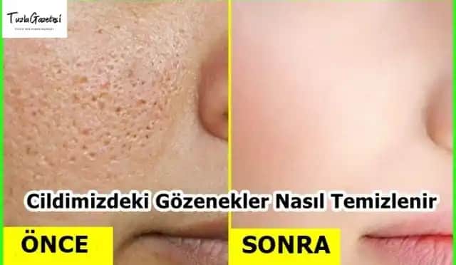 Gözeneklerde Yağ Birikimi ve Çözüm Yolları: Etkili Bakım ve Profesyonel Uygulamalar